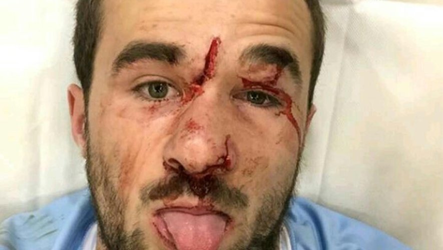 L'impressionnante blessure de Martin Laveau (Bayonne) - 18 février 2016